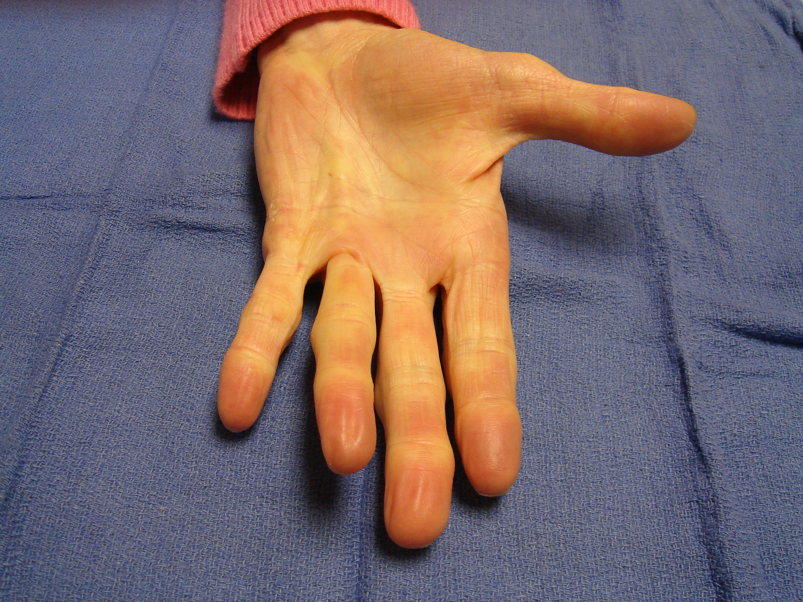 Figure 1f: The patient 9 months after first cycle enzyme treatment with recurrence of the (incompletely corrected) fourth ray cord; a second collagenase injection cycle was elected for the fourth ray.