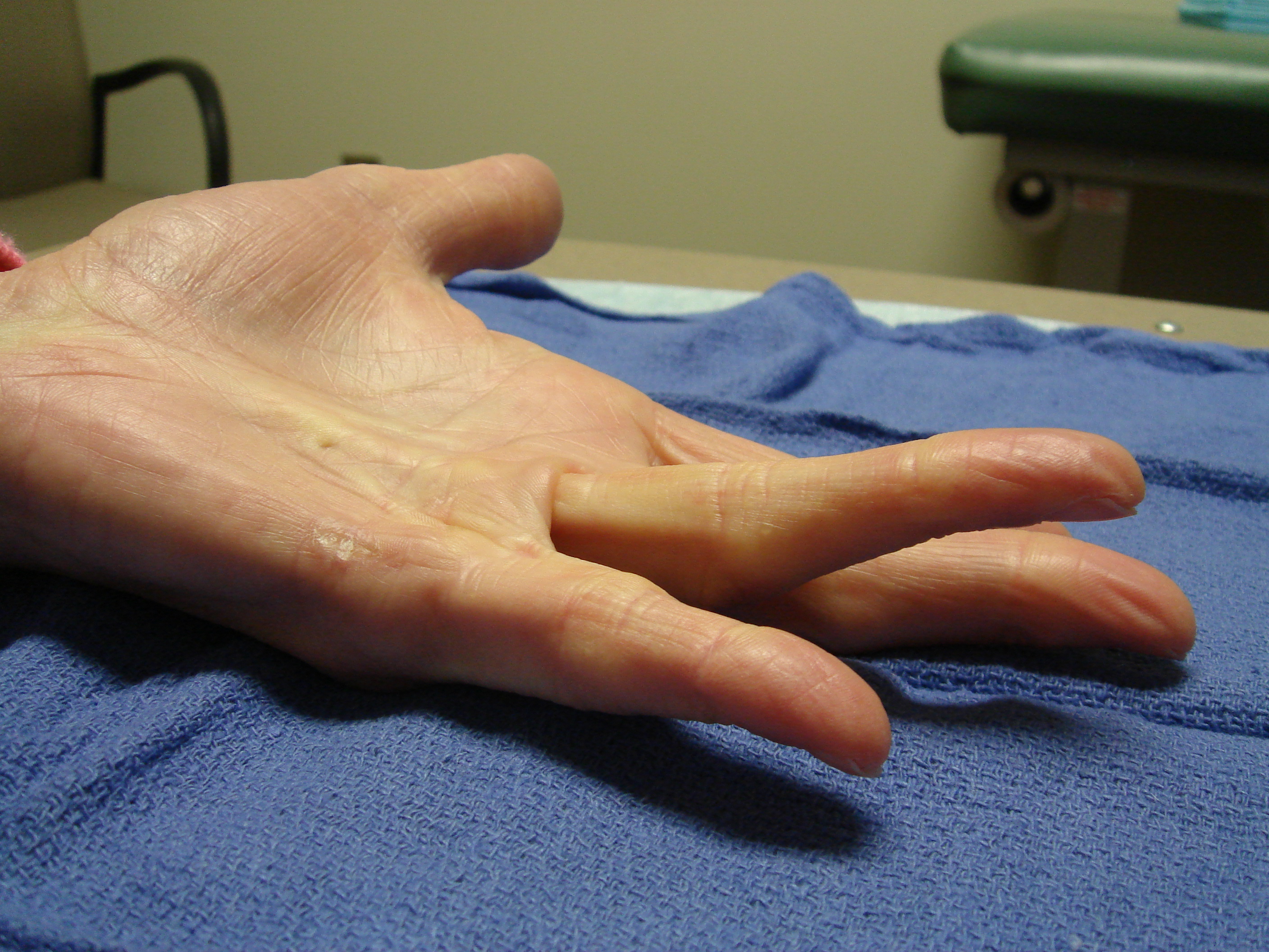 Figure 1g: The patient 9 months after first cycle enzyme treatment with recurrence of the (incompletely corrected) fourth ray cord; a second collagenase injection cycle was elected for the fourth ray.