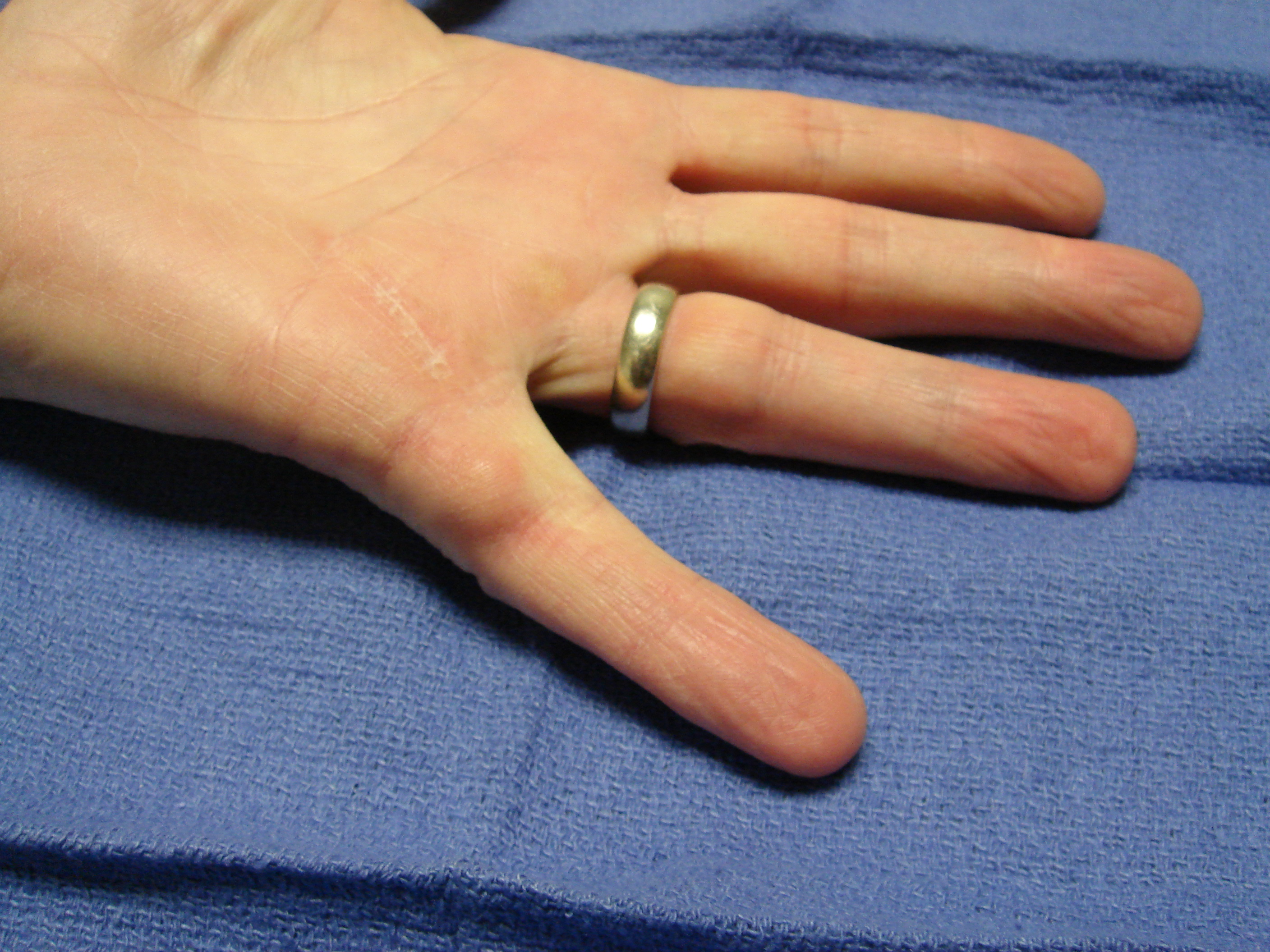 Figure 3d: Six months after collagenase treatment the patient maintains full active motion. A proximal phalangeal fascial nodule is seen slightly enlarged from pre-treatment; but there is yet no new contracture.