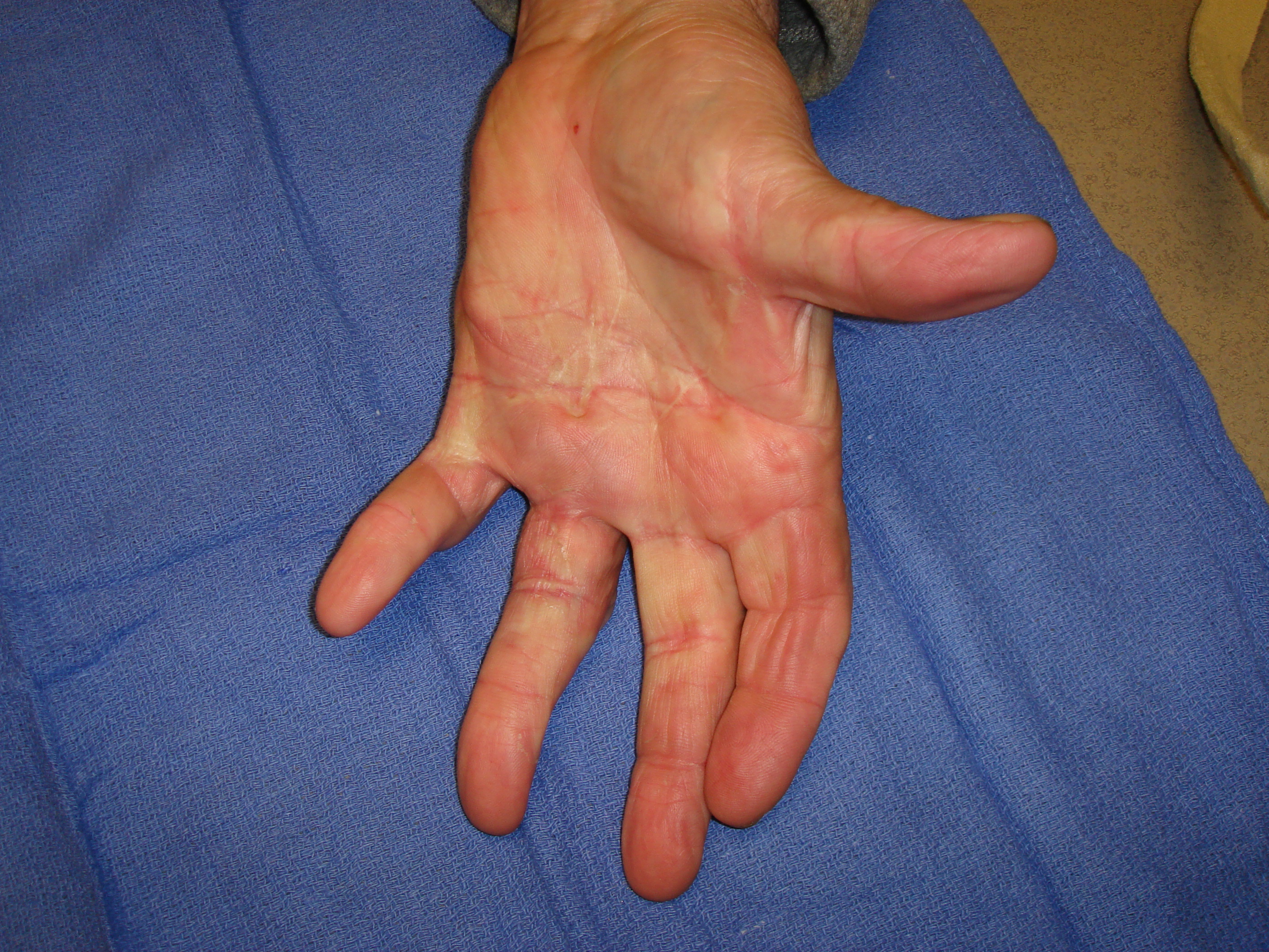 Figure 6i: These images were about 180 days after he completed his second collagenase treatment cycle that addressed the untreated/residual ring finger contractures. While some deformity persists, especially in the little finger PIP joint, he is quite functional and happy with his result.