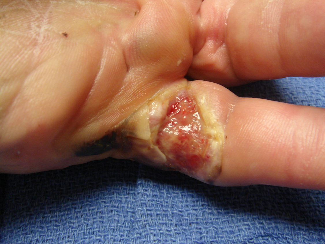 Figure 6e: Two weeks post-manipulation, the skin tear is granulating; he continues night MP+PIP extension splinting and has maintained active flexion.