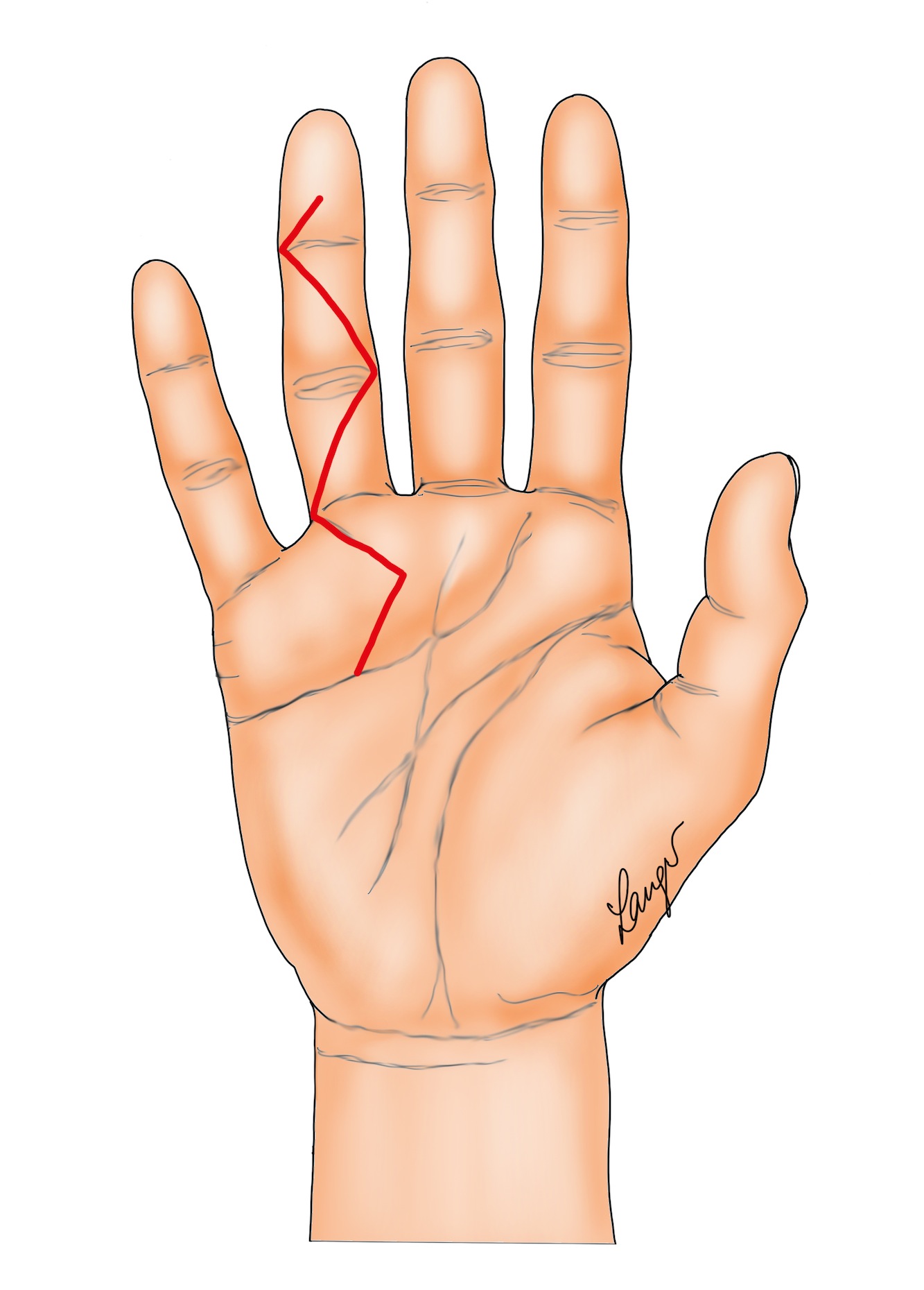 Figure 2: Formal Brunner incisions