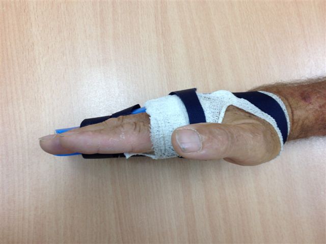 Figure 17a: The night splint