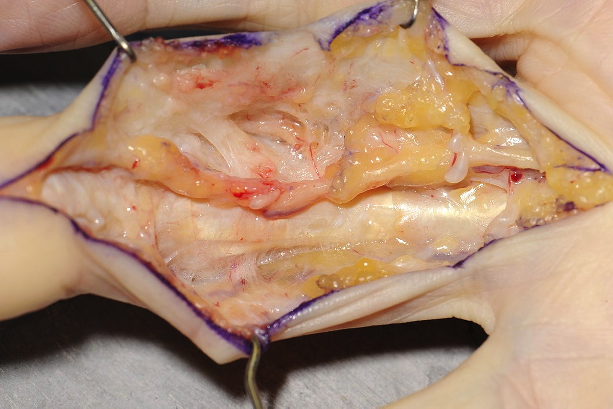 Figure 1: In this dissection disease has been removed from the radial side of the ring finger. Cleland’s ligament can be seen extending from the side of the middle phalanx into the skin and, in contrast to the ligament on the other side of the digit, is involved with Dupuytren’s disease. The neurovascular bundle, associated with several Pacinian corpuscles, can be seen overlying it.