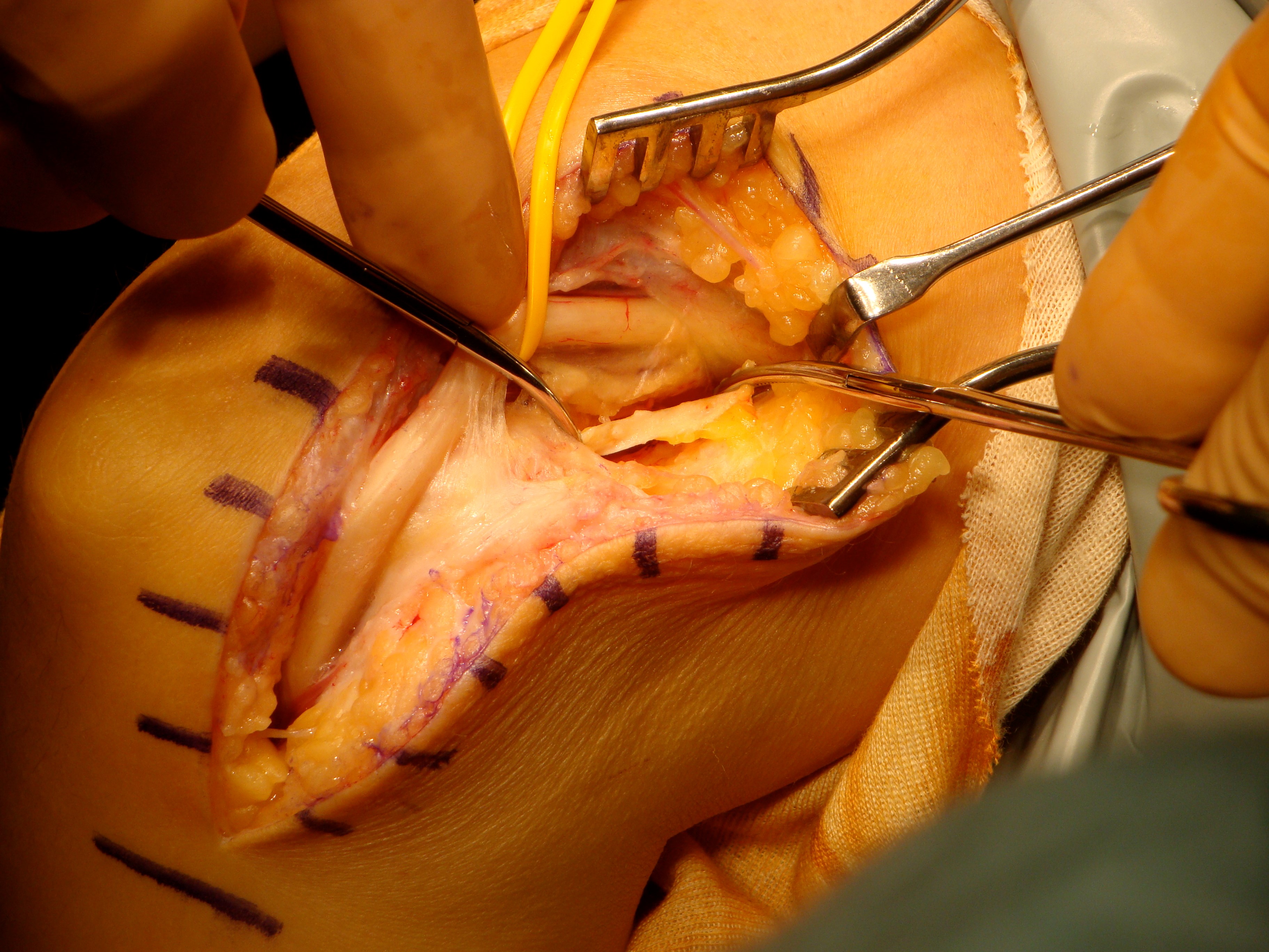 Figure 6: Medial intermuscular septum (shown anterior to ulnar nerve) must be excised when transposing the nerve