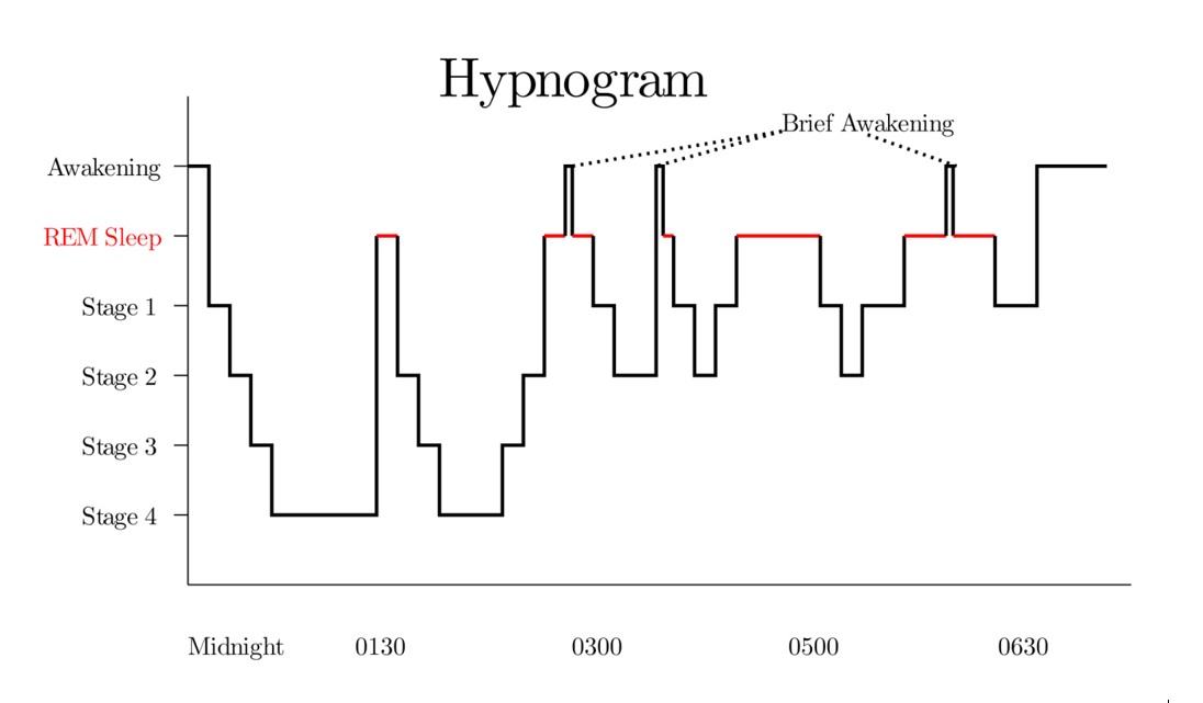 Abbildung 4: Verteilungsmuster der unterschiedlichen Schlafstadien einer Nacht ab Mitternacht bis zum Aufstehen um 6:30 Uhr bei einem gesunden Testschläfer im sogenannten ‚Hypnogramm‘. Man erkennt die Abfolge der Schlafstadien 1 bis 4 mit dem Wechsel in den REM-Schlaf. Mit zunehmender Schlafdauer nimmt der zeitliche REM-Anteil zu und der Non-REM-Anteil ab.
