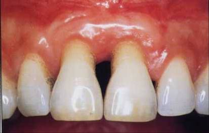 Abbildung 8: Parodontale Rezession (Recession parodontale von Damdent; die Abbildung ist von der CC-BY 4.0-Lizenzierung ausgenommen: Lizenz CC BY-SA 3.0)